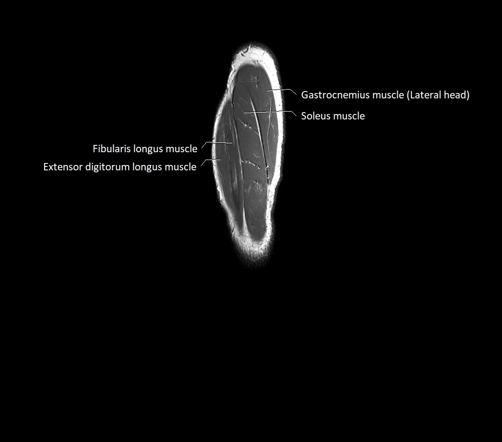 Lower leg sagittal anatomy 3T MRI image 3.webp